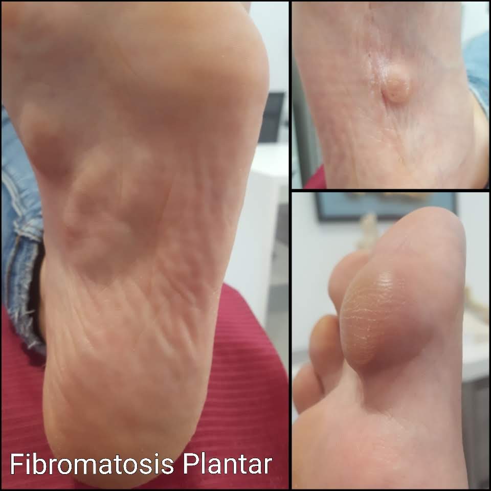 Fibromatosis plantar