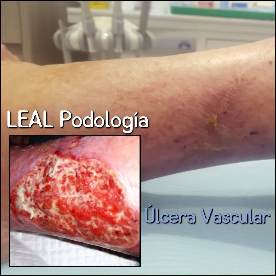 Ulcera vascular
